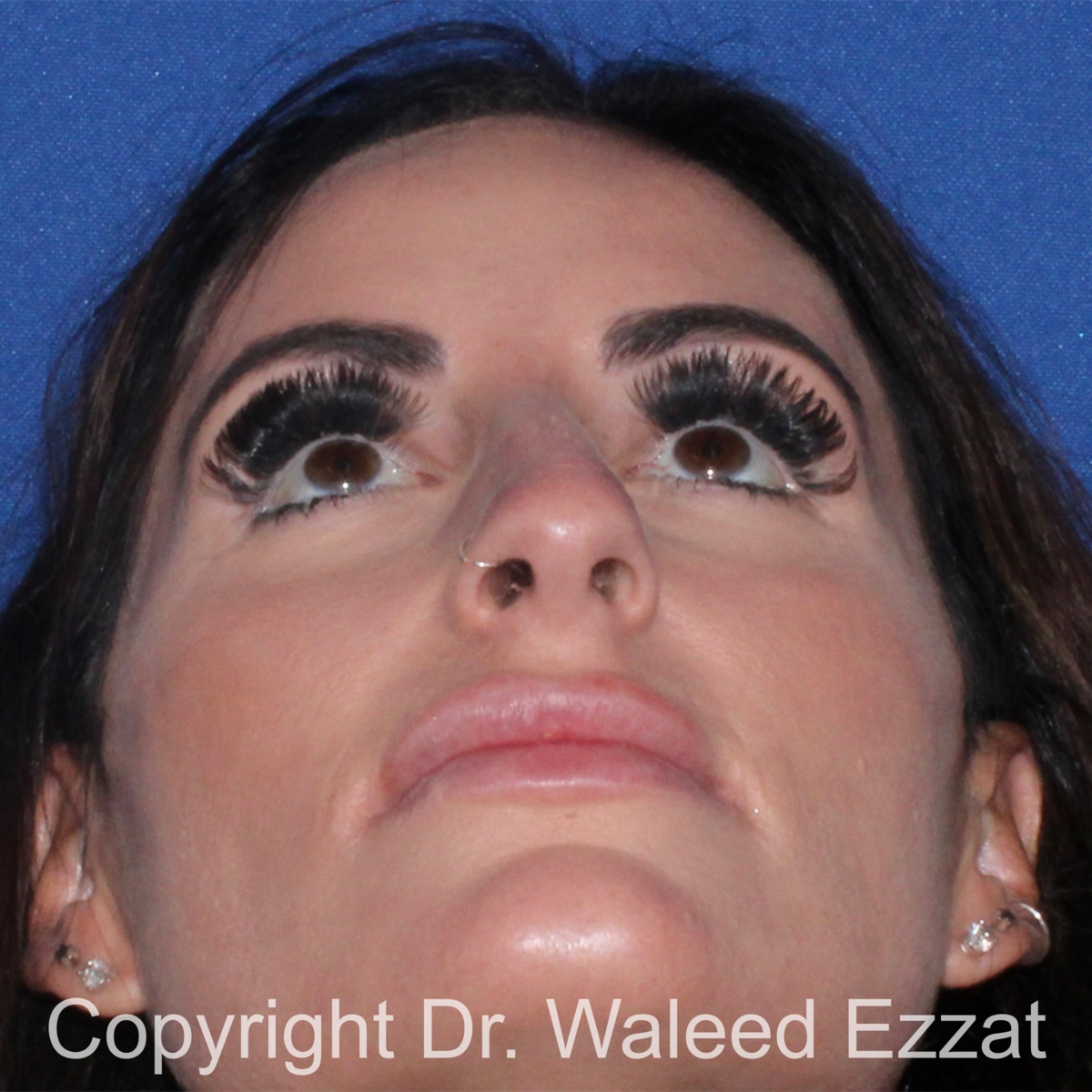Mediterranean/Middle Eastern Rhinoplasty Patient Photo - Case 652 - before view-3