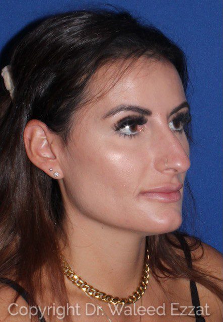 Mediterranean/Middle Eastern Rhinoplasty Patient Photo - Case 7033 - before view-1