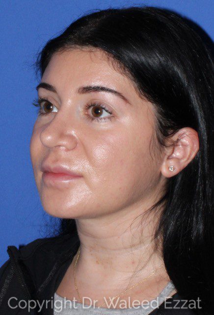 Mediterranean/Middle Eastern Rhinoplasty Patient Photo - Case 7039 - after view-1