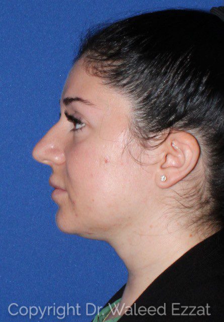 Mediterranean/Middle Eastern Rhinoplasty Patient Photo - Case 7039 - before view-