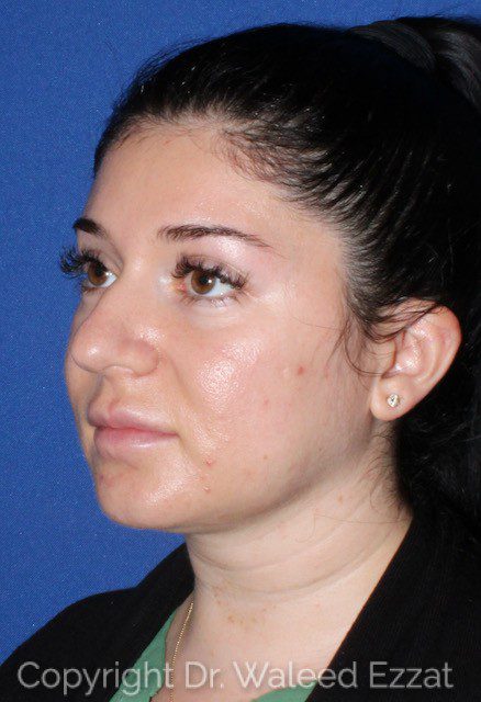 Mediterranean/Middle Eastern Rhinoplasty Patient Photo - Case 7039 - before view-1