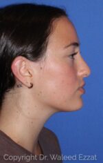 Caucasian/European Rhinoplasty - Case 7051 - Before