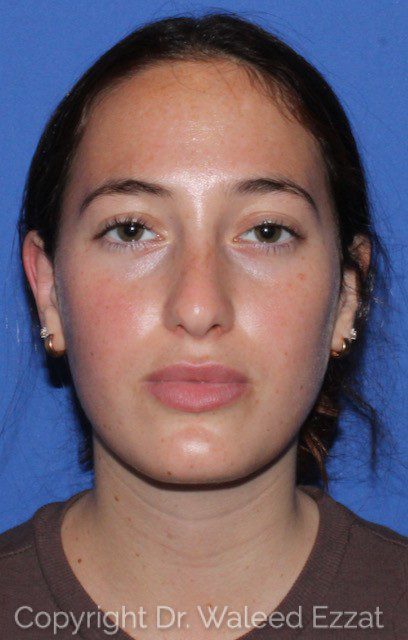 Caucasian/European Rhinoplasty Patient Photo - Case 7051 - before view-1