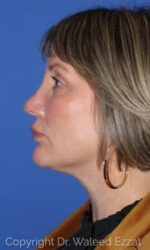 Caucasian/European Rhinoplasty - Case 7059 - After