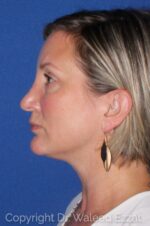 Caucasian/European Rhinoplasty - Case 7059 - Before
