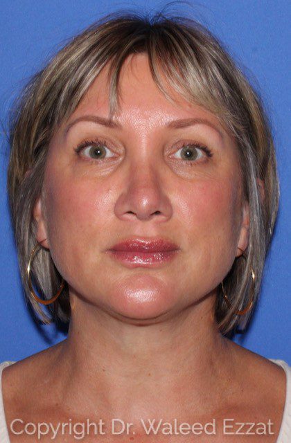 Caucasian/European Rhinoplasty Patient Photo - Case 7059 - after view-2