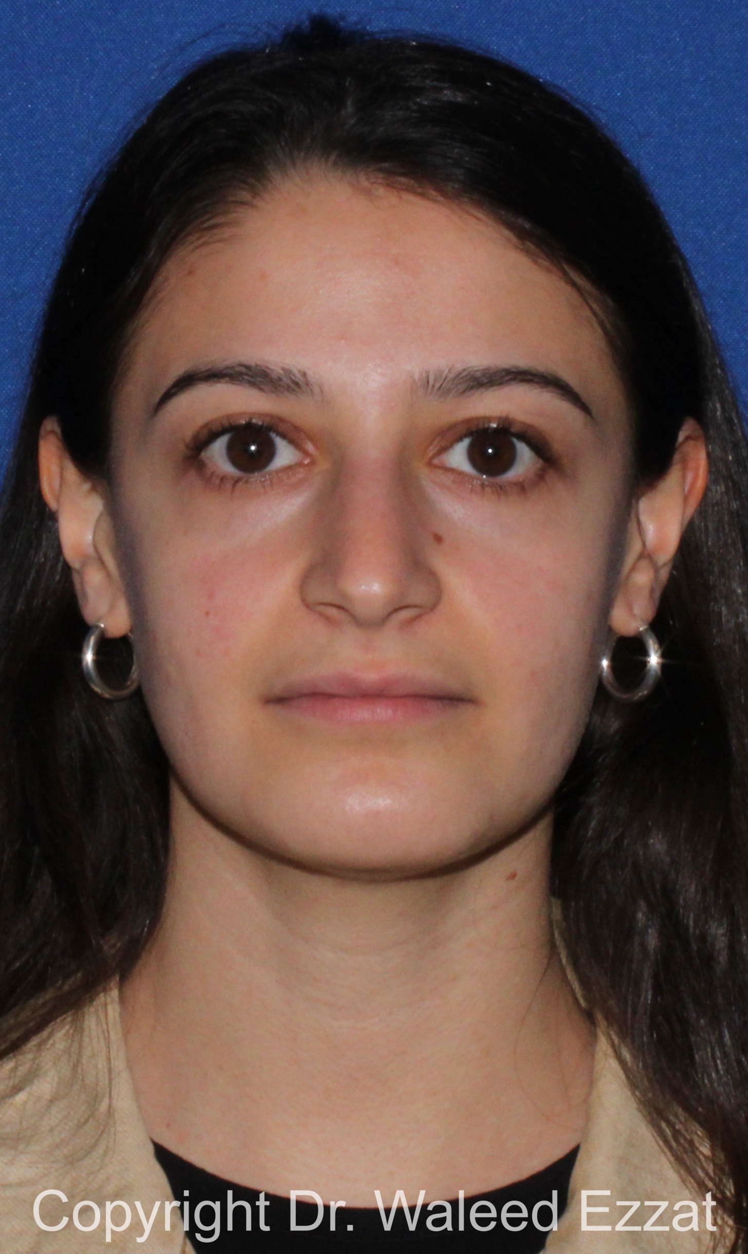 Rhinoplasty Patient Photo - Case 88 - before view-2