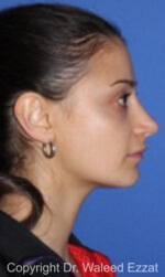 Caucasian/European Rhinoplasty - Case 88 - After