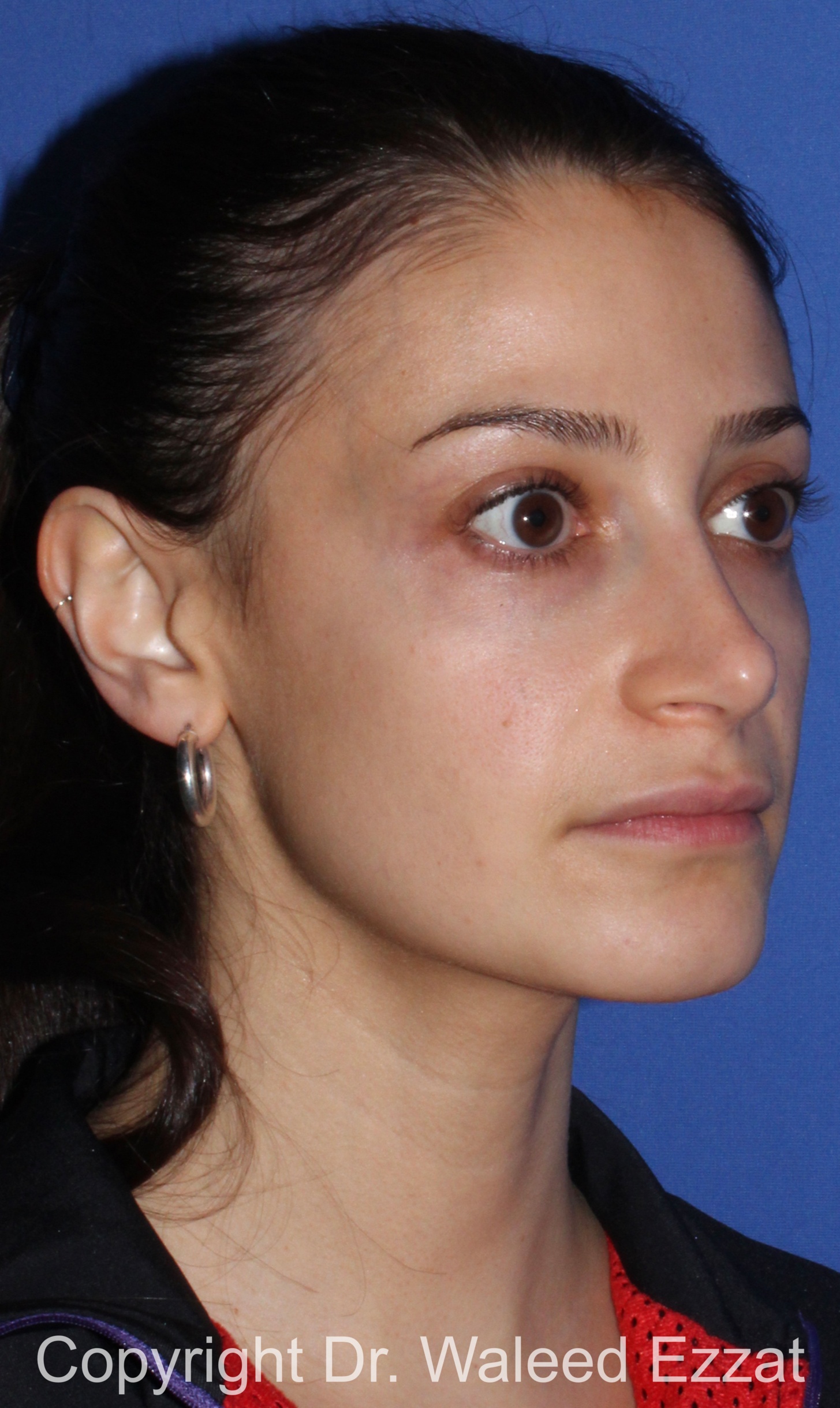 Rhinoplasty Patient Photo - Case 88 - after view-1