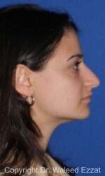 Caucasian/European Rhinoplasty - Case 88 - Before