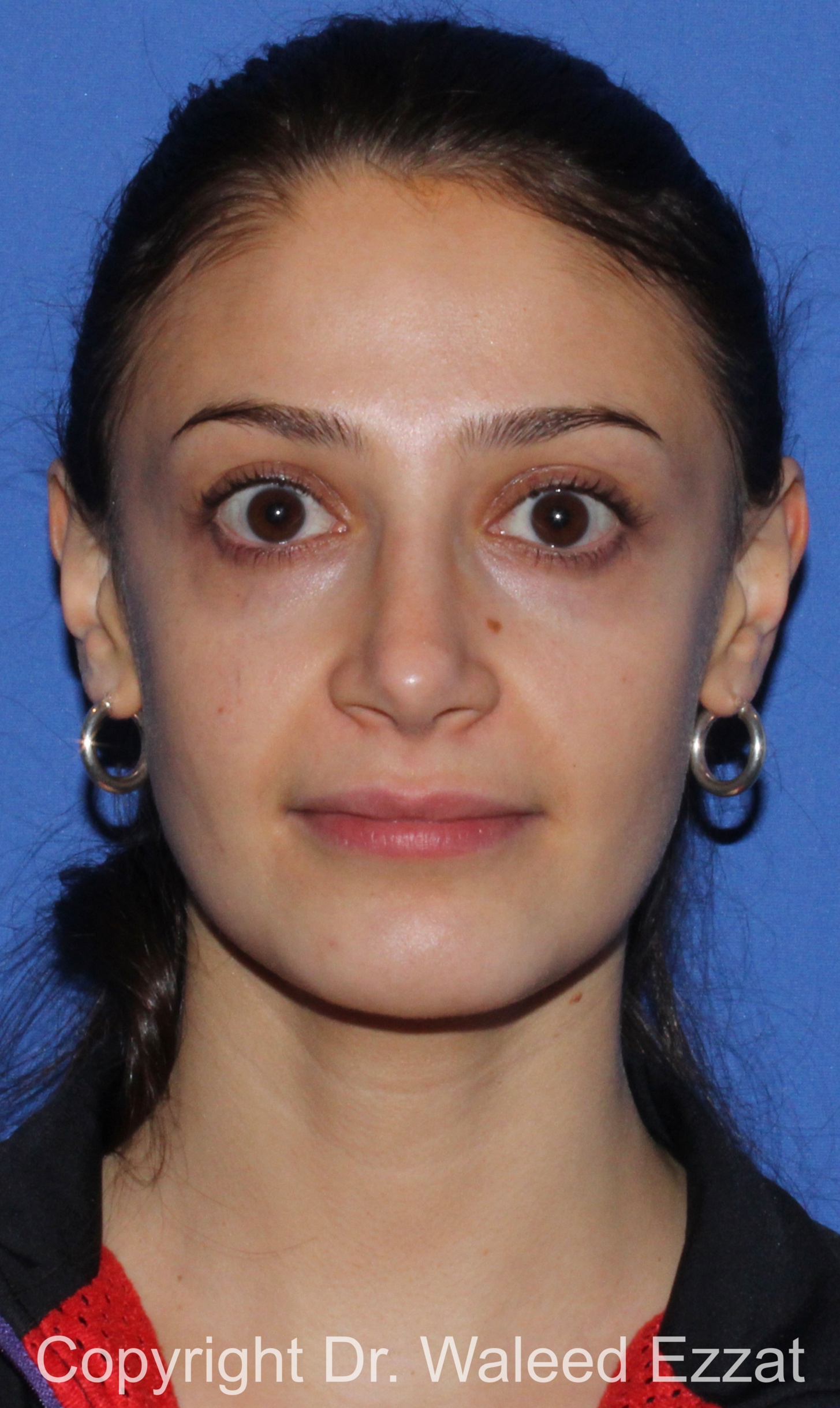 Rhinoplasty Patient Photo - Case 88 - after view-2