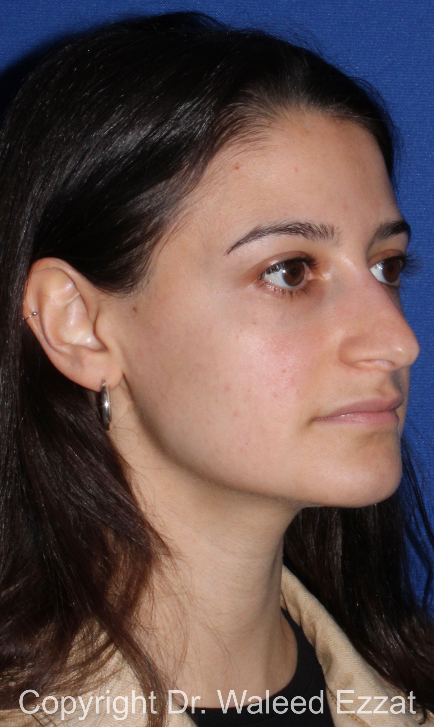 Rhinoplasty Patient Photo - Case 88 - before view-1