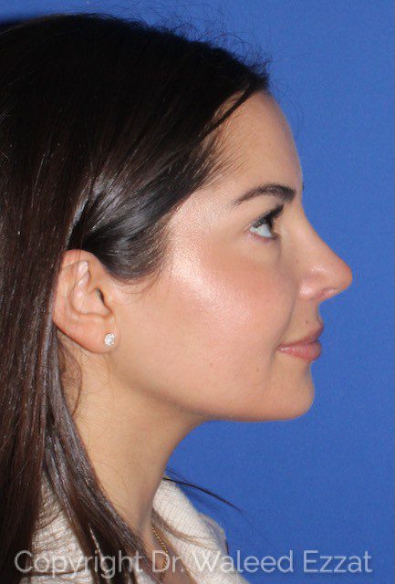 Mediterranean/Middle Eastern Rhinoplasty Patient Photo - Case 7073 - after view-0