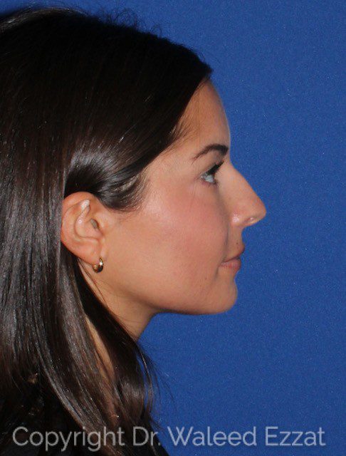 Mediterranean/Middle Eastern Rhinoplasty Patient Photo - Case 7073 - before view-