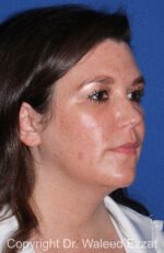 Facial Contouring - Case 142 - Before