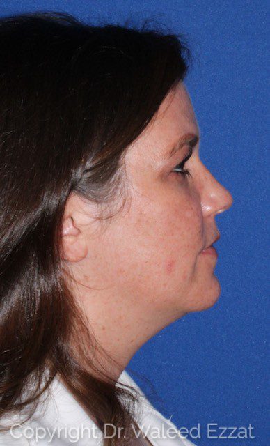 Facial Contouring Patient Photo - Case 7079 - before view-1