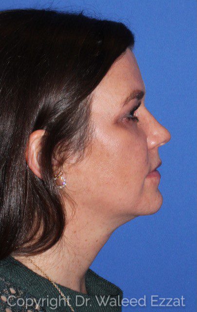 Facial Contouring Patient Photo - Case 7079 - after view-1