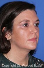 Facial Contouring - Case 142 - After