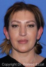 Otoplasty (Ear Re-Shaping Surgery) - Case 7087 - Before