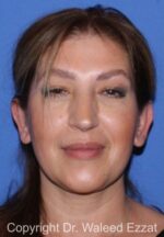 Otoplasty (Ear Re-Shaping Surgery) - Case 7087 - After