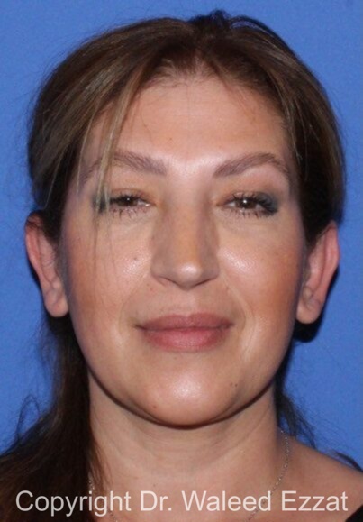 Otoplasty (Ear Re-Shaping Surgery) Patient Photo - Case 7087 - after view