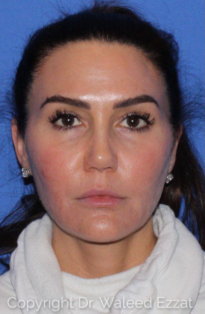 Mediterranean/Middle Eastern Rhinoplasty Patient Photo - Case 7091 - after view-2