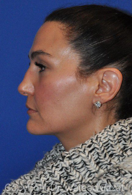 Mediterranean/Middle Eastern Rhinoplasty Patient Photo - Case 7091 - before view-0