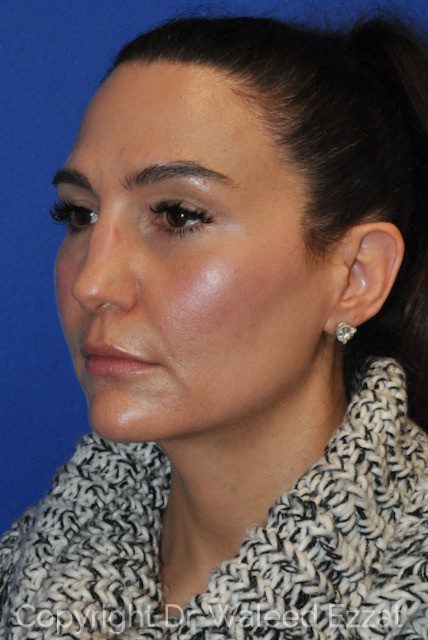 Mediterranean/Middle Eastern Rhinoplasty Patient Photo - Case 7091 - before view-1