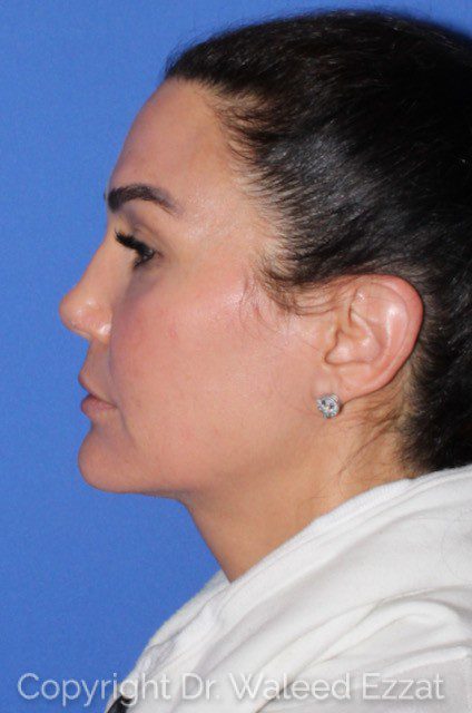 Mediterranean/Middle Eastern Rhinoplasty Patient Photo - Case 7091 - after view-0