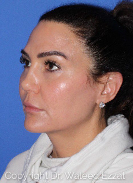 Mediterranean/Middle Eastern Rhinoplasty Patient Photo - Case 7091 - after view-1