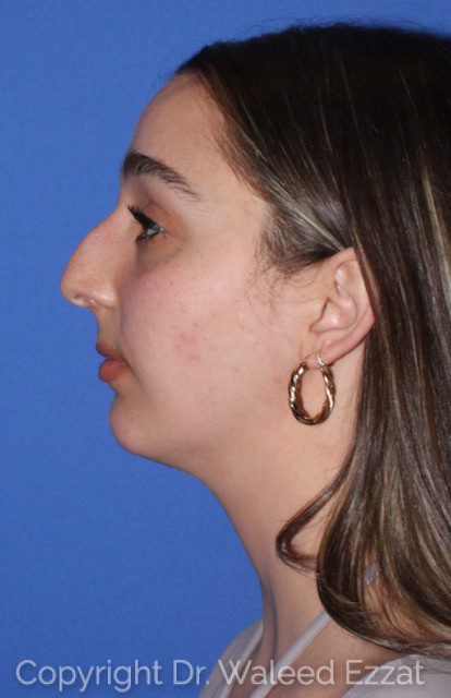 Mediterranean/Middle Eastern Rhinoplasty Patient Photo - Case 7100 - before view-0
