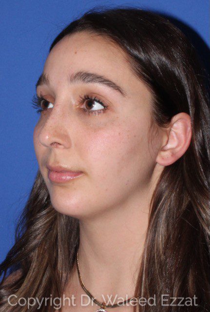 Mediterranean/Middle Eastern Rhinoplasty Patient Photo - Case 7100 - after view-1