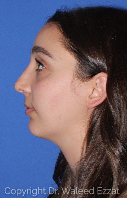 Mediterranean/Middle Eastern Rhinoplasty Patient Photo - Case 7100 - after view-0