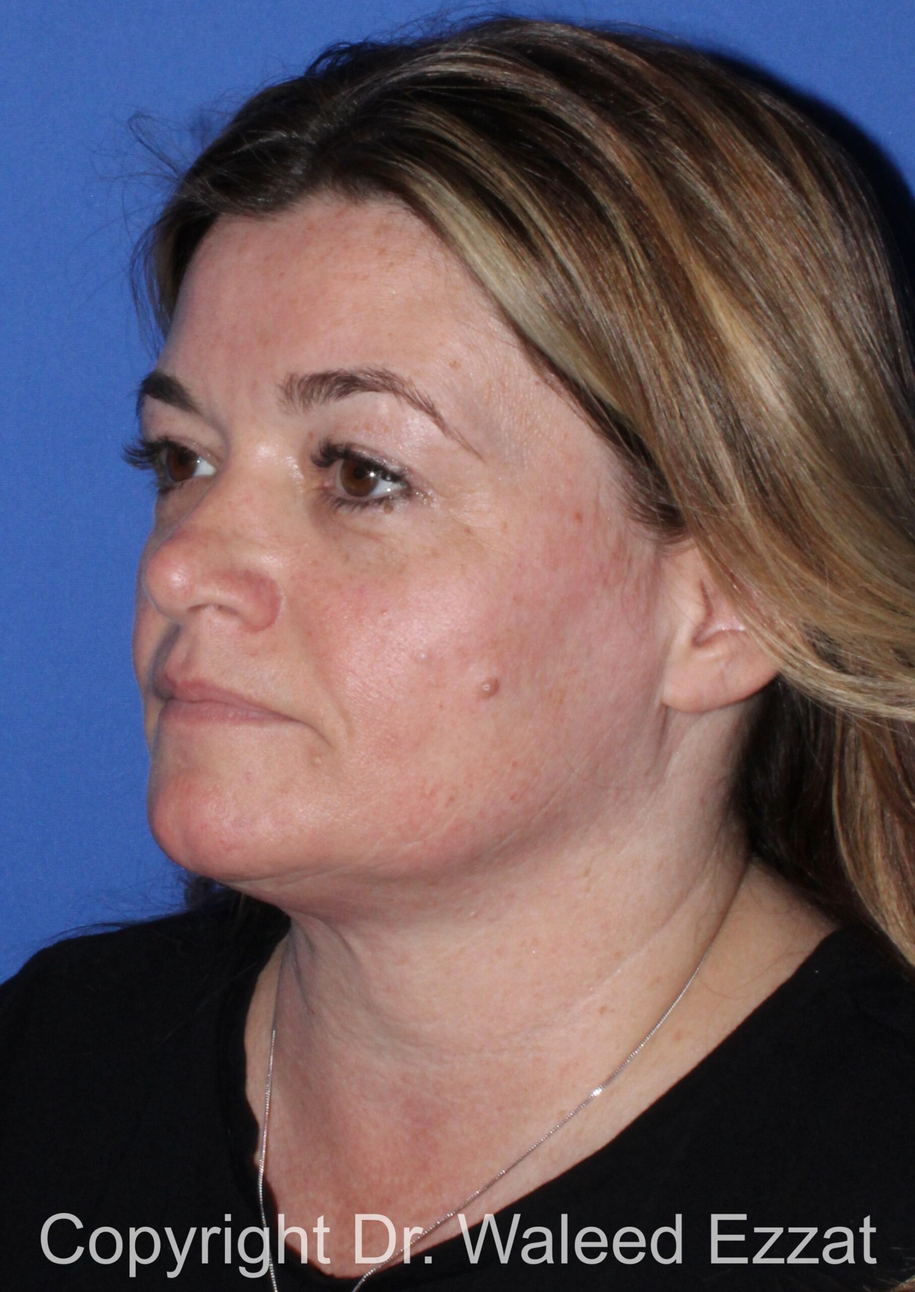 Blepharoplasty Patient Photo - Case 17 - before view-1