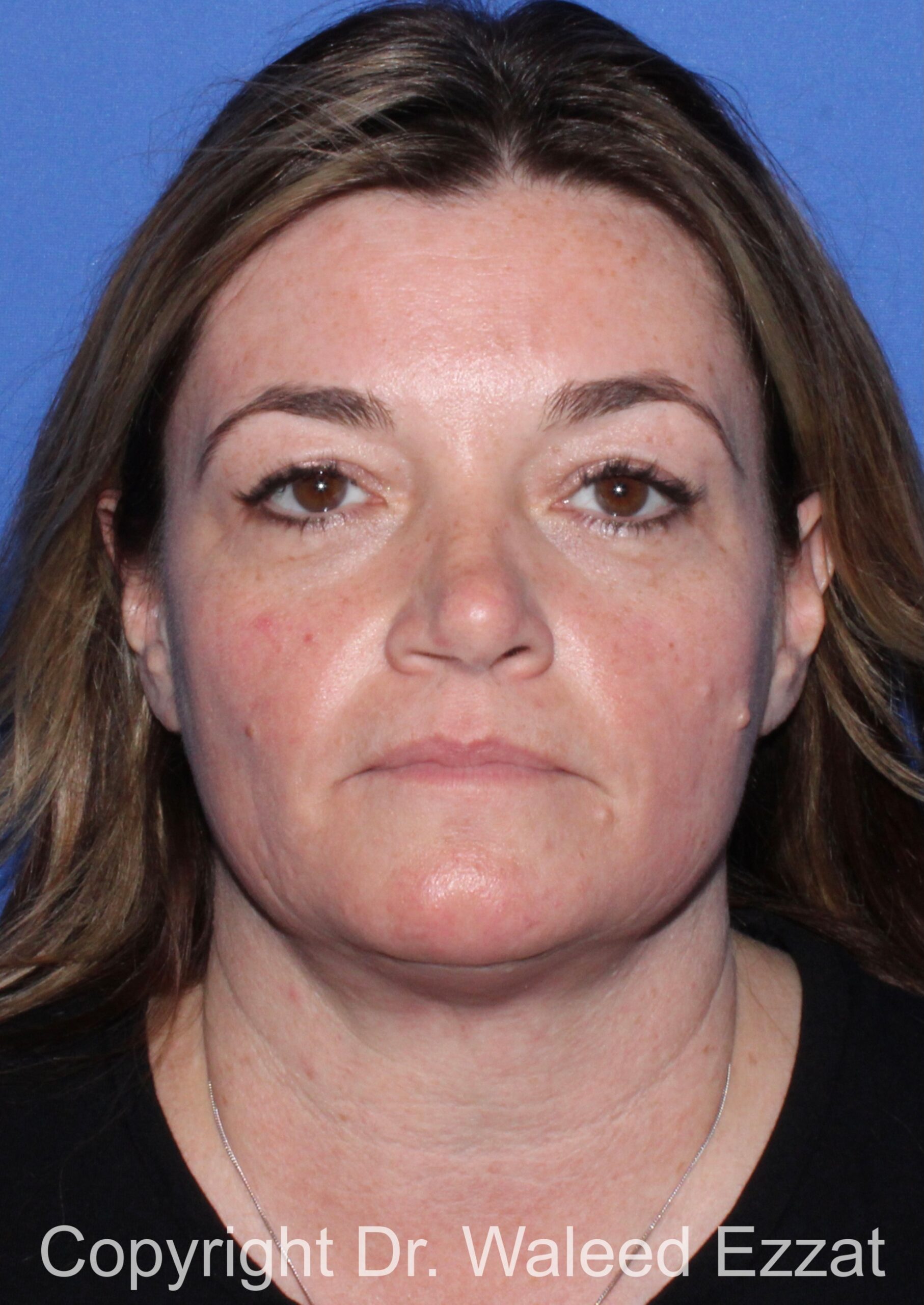 Blepharoplasty Patient Photo - Case 17 - before view-2