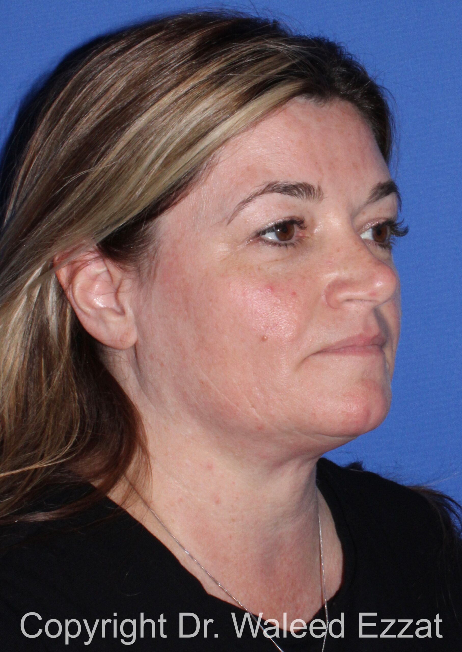 Blepharoplasty Patient Photo - Case 17 - before view-