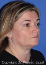 Blepharoplasty - Case 17 - After