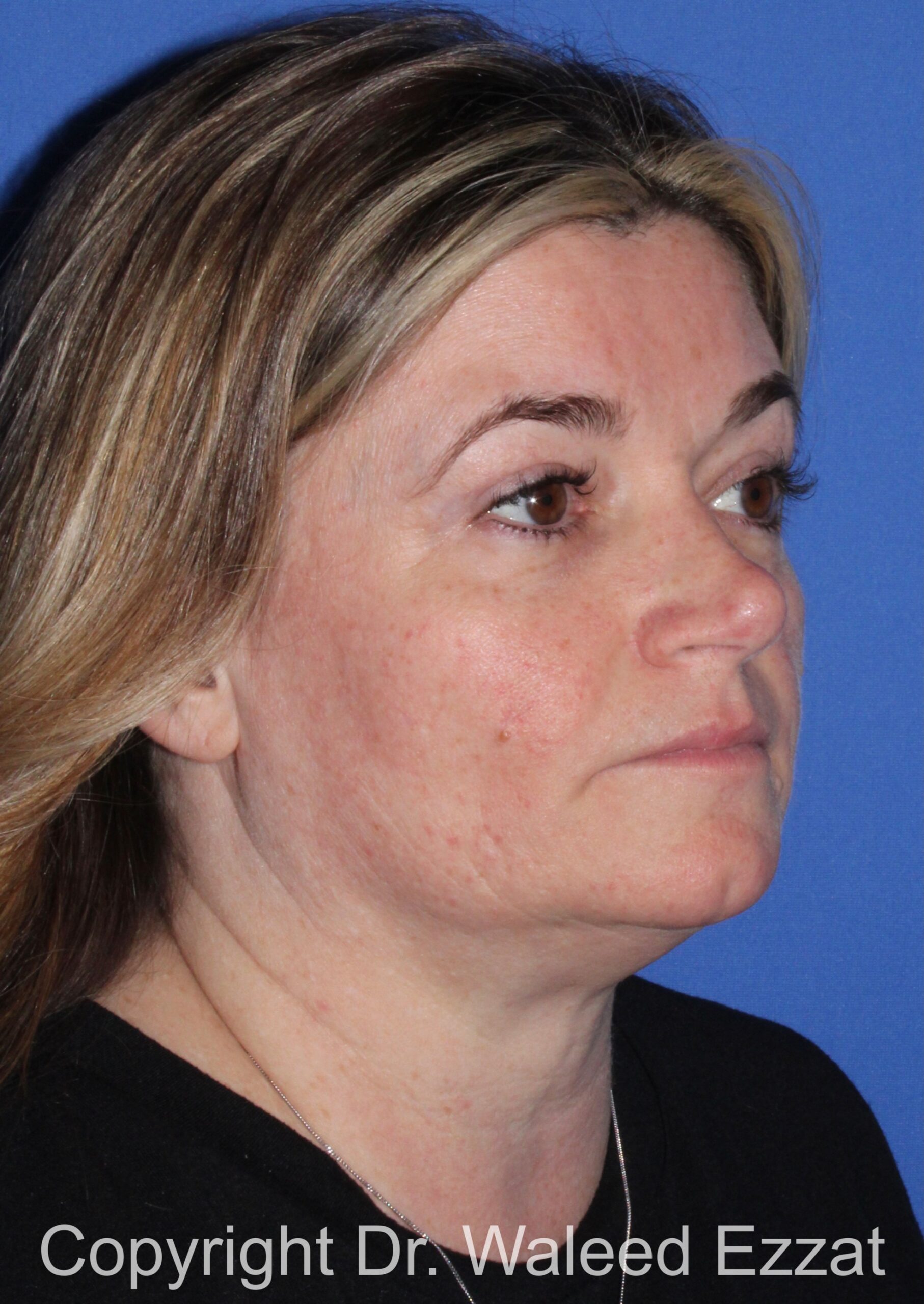 Blepharoplasty Patient Photo - Case 17 - after view