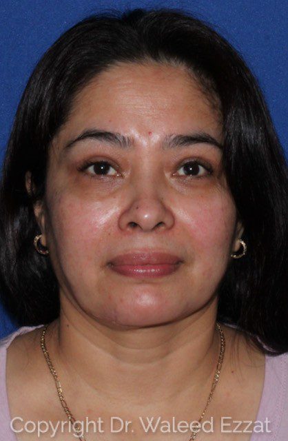 Blepharoplasty Patient Photo - Case 7112 - after view