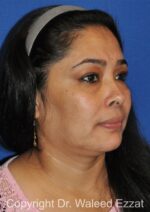 Blepharoplasty - Case 18 - Before