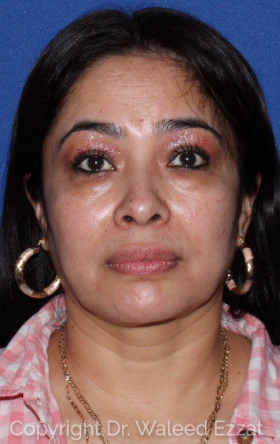 Blepharoplasty Patient Photo - Case 7112 - before view-0