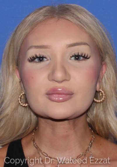 Rhinoplasty Patient Photo - Case 7236 - after view-1