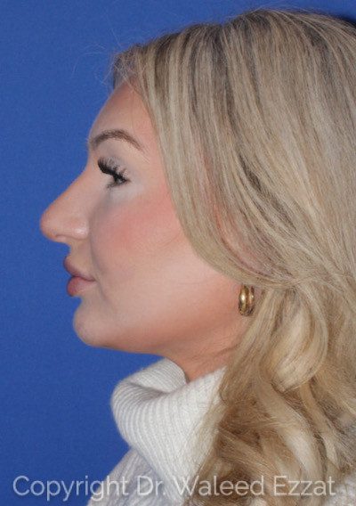 Rhinoplasty Patient Photo - Case 7236 - before view-