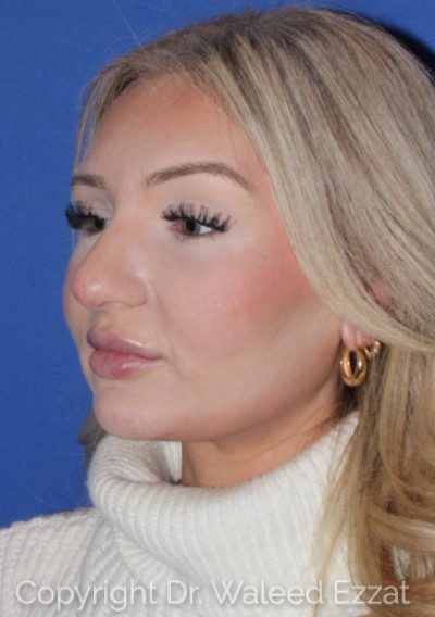 Rhinoplasty Patient Photo - Case 7236 - before view-2