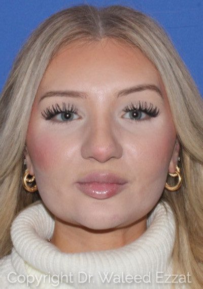 Rhinoplasty Patient Photo - Case 7236 - before view-1