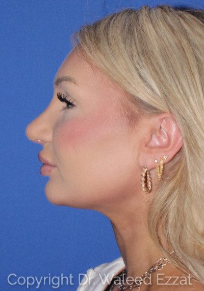 Rhinoplasty Patient Photo - Case 7236 - after view-0