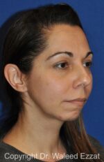 Cheek Lift - Case 25 - Before