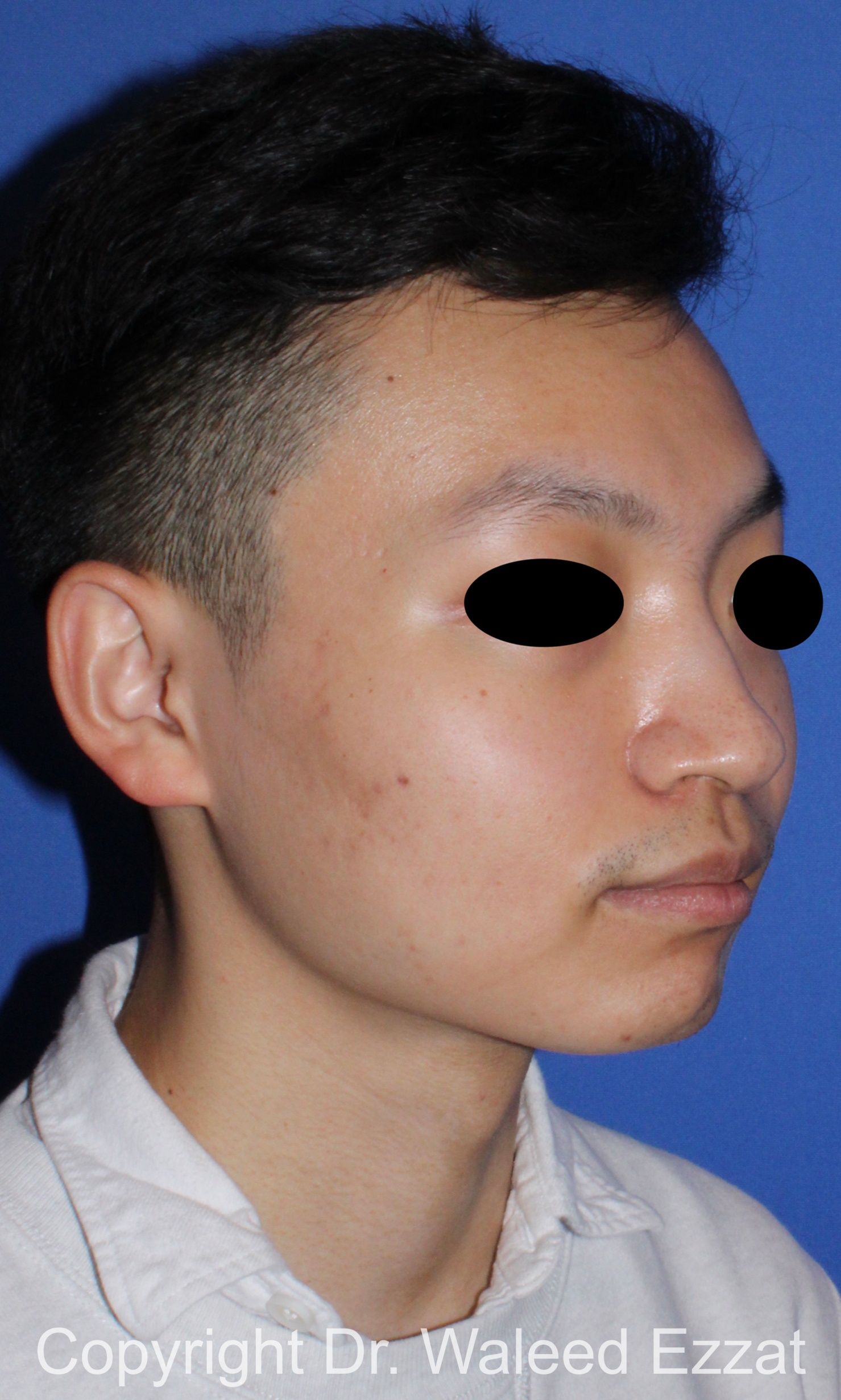 East Asian Rhinoplasty Patient Photo - Case 212 - before view-1