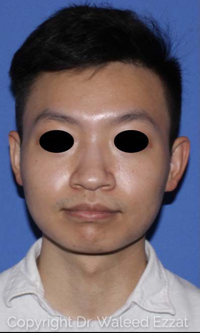 East Asian Rhinoplasty Patient Photo - Case 7491 - before view-2