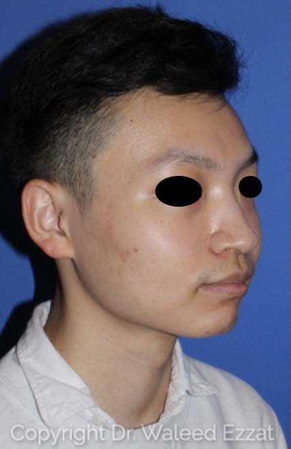 East Asian Rhinoplasty Patient Photo - Case 7491 - before view-